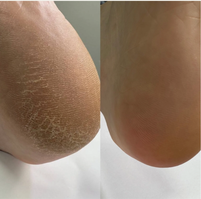 Podology+ Keratolytikum – 100 ml
Sanfte Exfoliation & intensive Pflege mit 20 % Urea